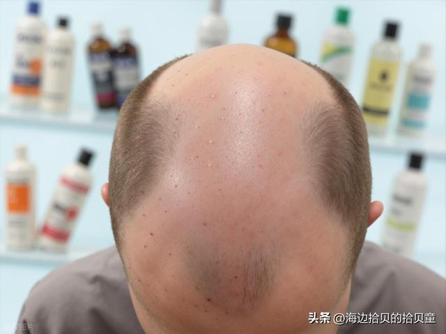 什么生发液真实可以生发？育发最有效的产品排名！